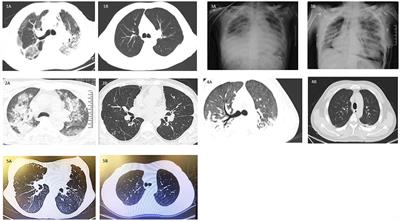 Case Report: Delayed Lung Transplantation With Intraoperative ECMO Support for Herbicide Intoxication-Related Irreversible Pulmonary Fibrosis: Strategy and Outcome
